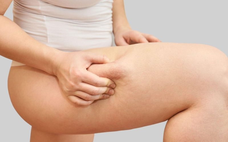 Nouveau Dermé Introduces Body Contouring Program