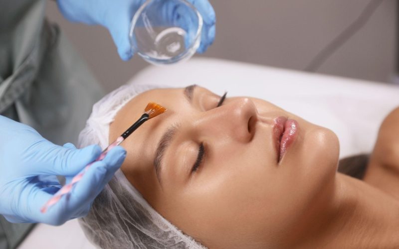 DSC Expands Chemical Peel Treatments for Pigmentation in LA